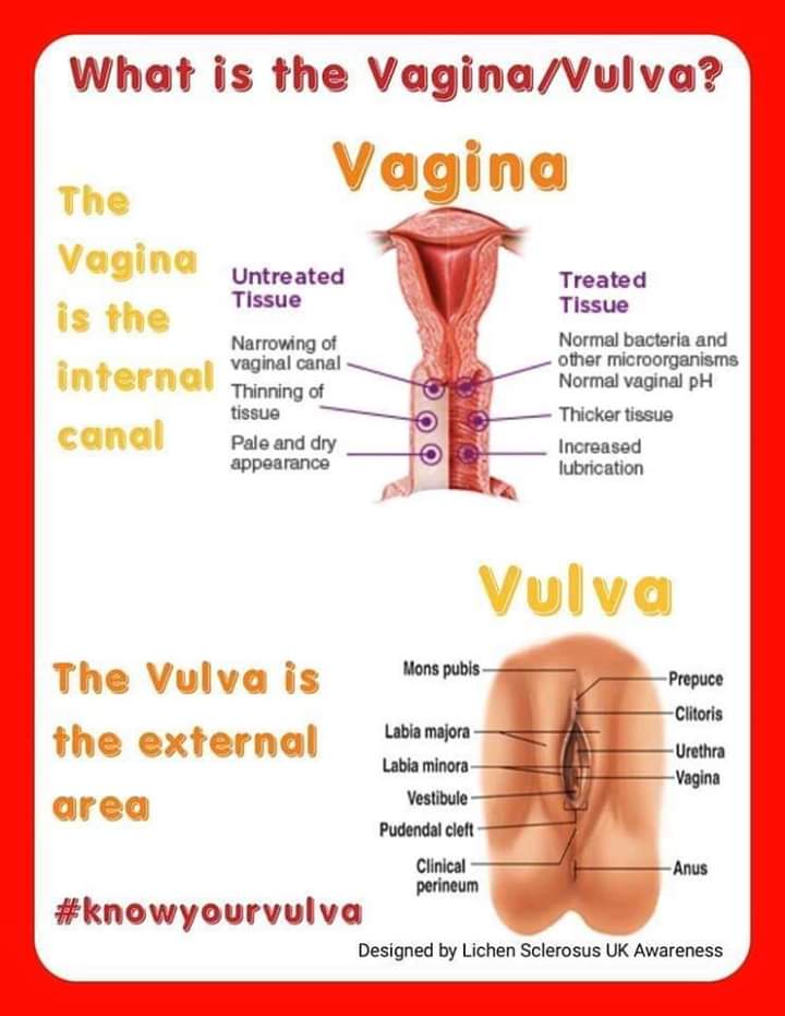 Vaginal Atrophy ~ Why is everything such a battle for us by Adele - Lichen  Sclerosus & Vulval cancer UK Awareness